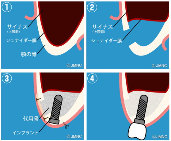 サイナスリフト法（上顎洞底拳上術）