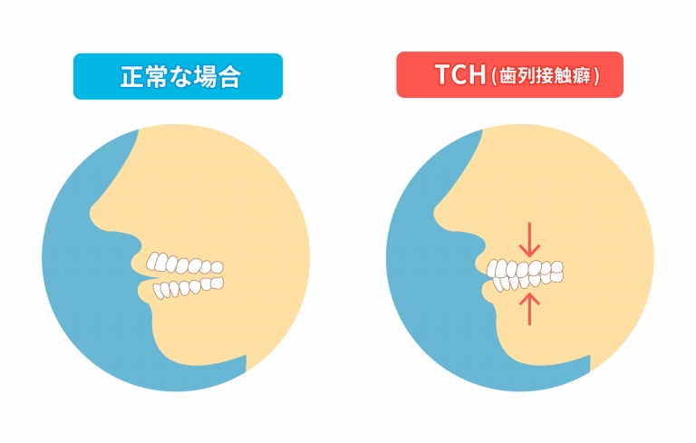 顎関節症（顎が痛い・音がする）とは