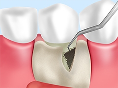 歯周外科治療(フラップ手術)
