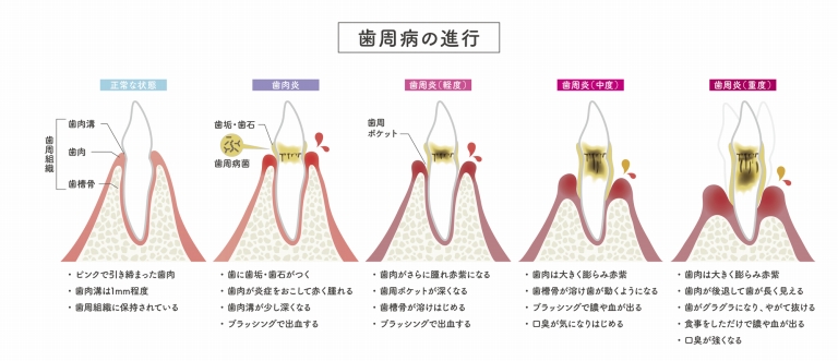 歯周病の進行段階