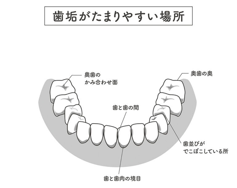 歯垢・歯石が残りやすい場所